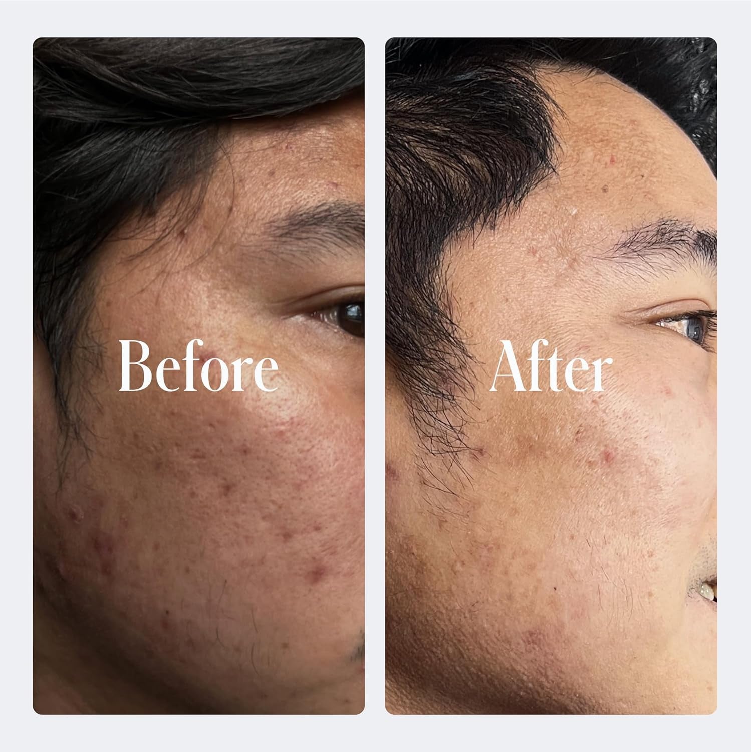 Retinol Anti-Aging Face Cream | Enhanced .2% Retinol Formula for Effective Results | Reduce Fine Lines & Wrinkles | Protect & Repair Skin with Hyaluronic Acid & Niacinamide | for Men & Women